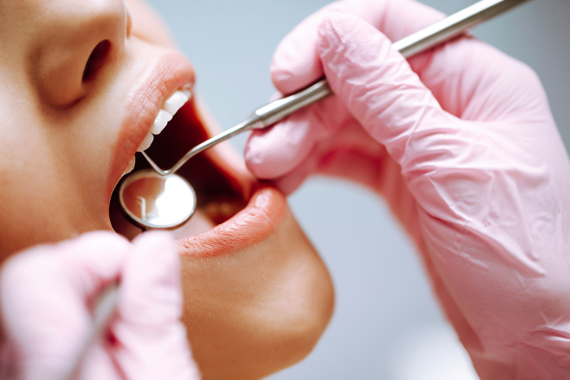 Young woman at the dentist's chair during a dental procedure. Overview of dental caries prevention.